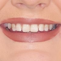 Composite Veneers - Smile 4 before